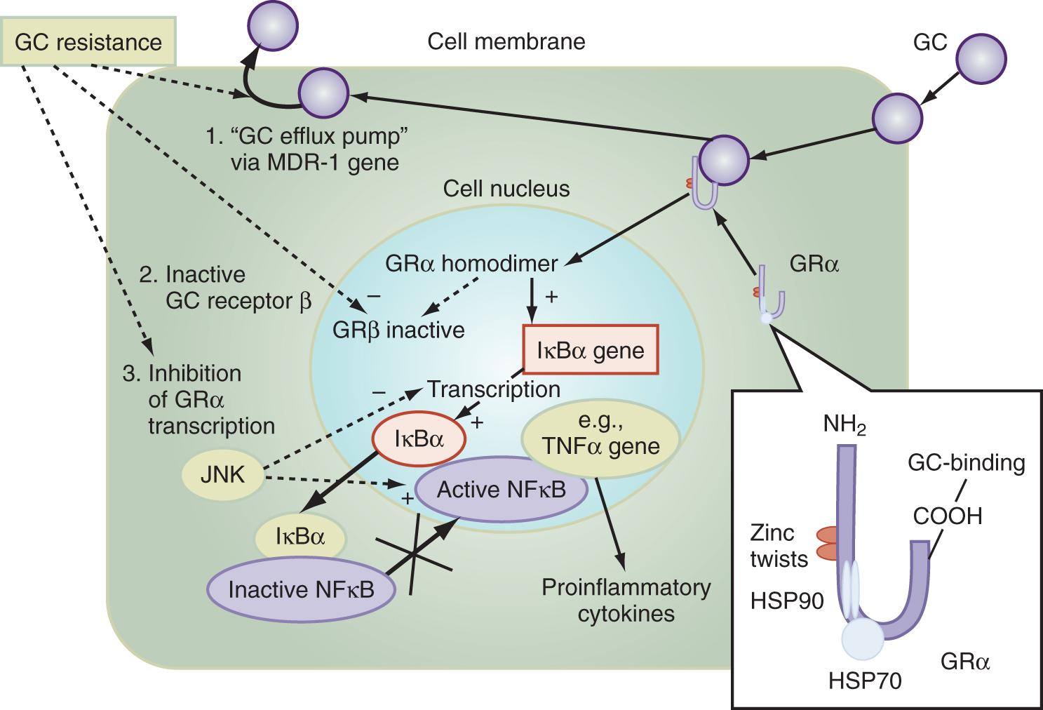 Fig. 136.1, Cellular mechanisms of glucocorticoid effects (right) and glucocorticoid resistance (left).