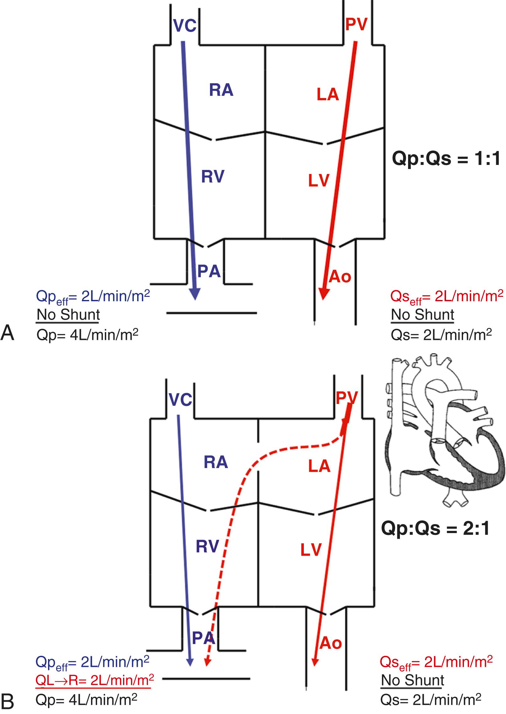 Figure 16.1, Diagram comparing (A) a normal heart and (B) a heart with an atrial septal defect (ASD) to depict the concepts of physiologic shunt (recirculated flow), effective blood flow (nutritive flow), and total pulmonary blood flow (Q P ) and total systemic blood flow (Q S ) . See description in the text. Ao , Aorta; LA , left atrium; LV , left ventricle; PA , pulmonary artery; PV , pulmonary vein; RA , right atrium; RV , right ventricle; VC , vena cava; QL-R , left to right shunt; QPeff , effective pulmonary blood flow; QSeff , effective systemic blood flow.