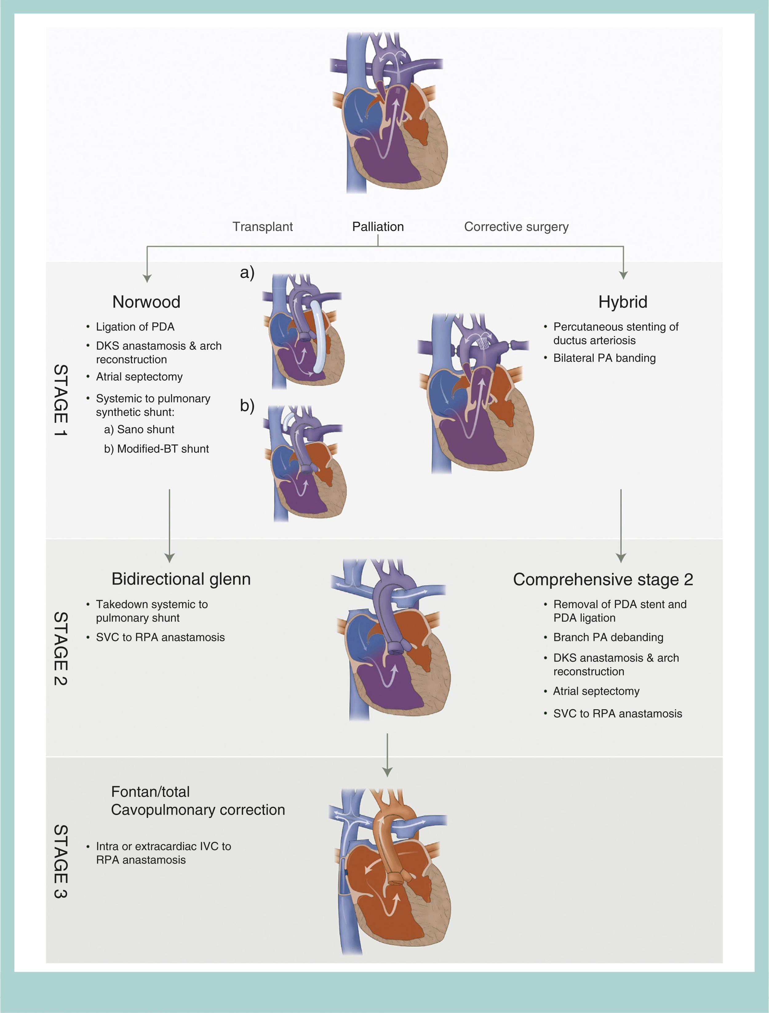 Figure 16.4, Depiction of the various pathways used to palliate hypoplastic left heart syndrome (HLHS) to a Fontan circulation. BT , Blalock-Taussig; DKS , Damus-Kaye-Stansel; IVC , inferior vena cava; PA , pulmonary artery; PDA , patent ductus arteriosus; RPA , right pulmonary artery; SVC , superior vena cava.