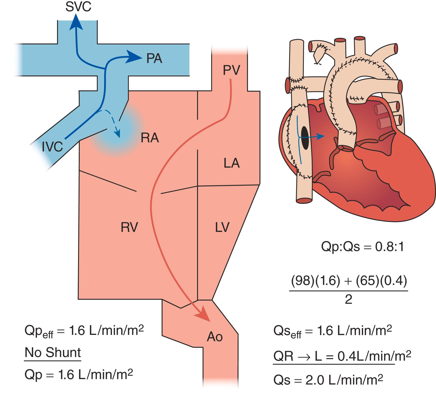 Figure 16.5, Diagram depicting chamber oxygen saturations and flows in single-ventricle patient (hypoplastic left heart syndrome) palliated with a fenestrated lateral Fontan. A fenestration is present allowing a right-to-left (R-L) shunt as a “pop-off” to maintain cardiac output. Ao , Aorta; IVC , inferior vena cava; LA , left atrium; LV , left ventricle; SVC , superior vena cava; PA , pulmonary artery; RA , right atrium; RV , right ventricle.
