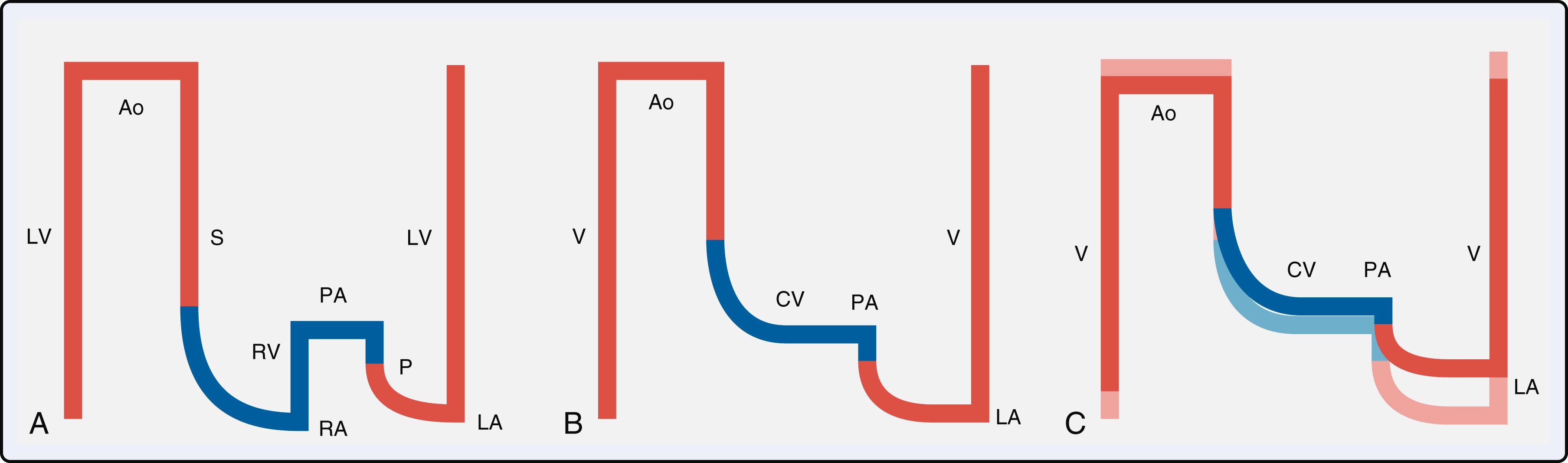 Figure 16.6, Diagram of normal cardiovascular circulation and Fontan circulation at early and late stages. (A) Normal biventricular circulation. The pulmonary circulation (P) is connected in series to the systemic circulation (S) . The right ventricle (RV) ensures that the right atrial pressure remains lower than the left atrial pressure and delivers the driving force to the blood to overcome pulmonary impedance. (B) Fontan circuit. The caval veins are directly connected to the pulmonary artery (PA) ; systemic venous pressures are markedly elevated. (C) Late Fontan circuit (superimposed on early Fontan circuit). With time, a negative spiral occurs. As pulmonary vascular resistance increases there is an increase in caval vein (CV) pressure leading to systemic venous congestion. Despite this increase in driving pressure there is a decrease in flow to the systemic ventricle leading to chronic volume underload. Chronic volume underload and lack of fiber stretch lead to a decrease contractility and an increase in muscle stiffness (impaired diastolic function) resulting in increasing ventricular filling pressures. Line thickness reflects output; color reflects oxygen saturation. Ao , Aorta; LA , left atrium; LV , left ventricle; RA , right atrium; V , single ventricle.