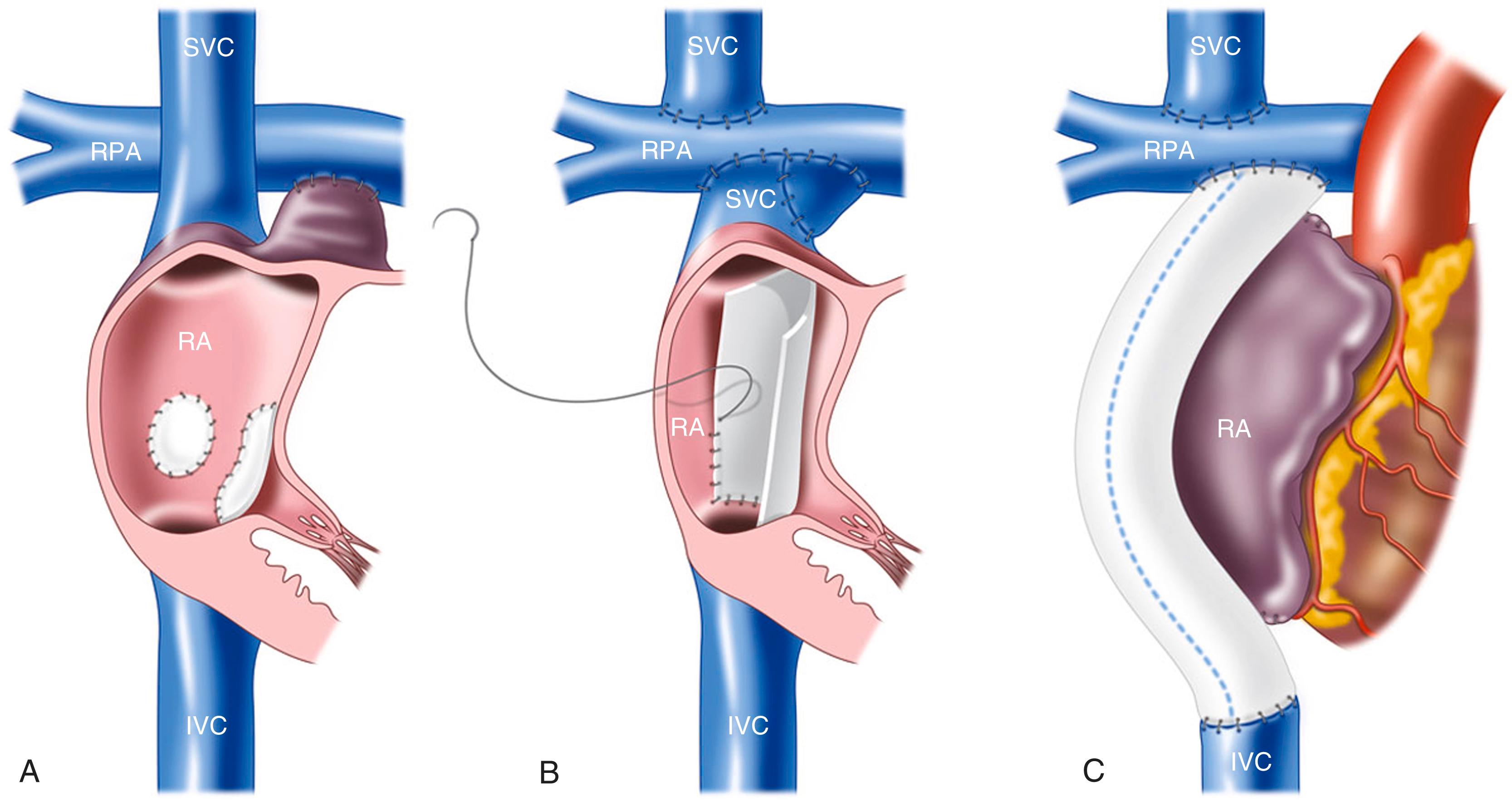 Figure 16.7, Diagram of variations of the Fontan procedure. (A) Atriopulmonary Fontan. (B) Lateral tunnel Fontan. (C) Extracardiac Fontan. IVC , inferior vena cava; RA , right atrium; RPA , right pulmonary artery; SVC , superior vena cava.