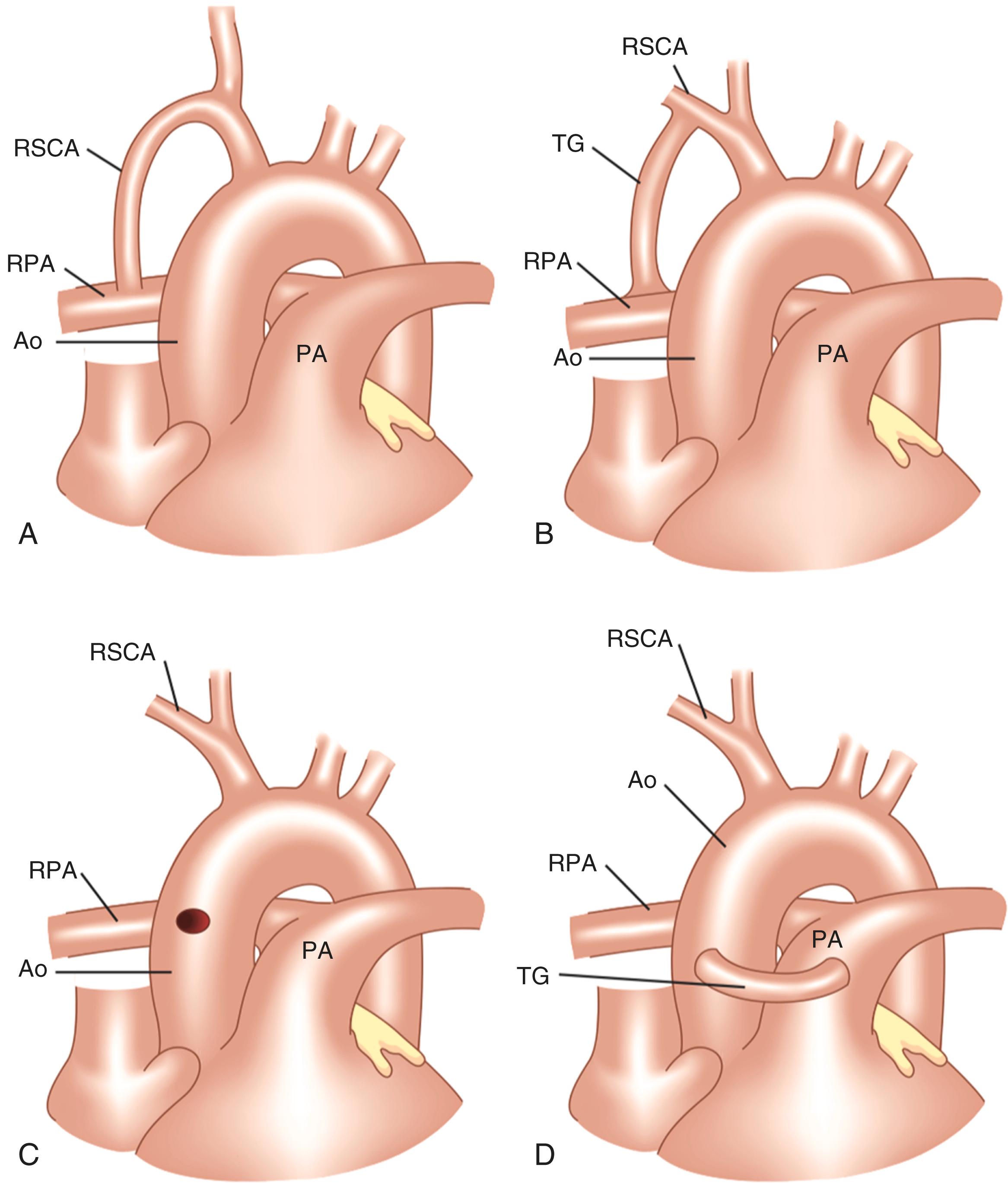 Figure 16.8, Depiction of aortopulmonary shunt types. (A) Classic Blalock-Taussig shunt, (B) modified Blalock-Taussig shunt, (C) Waterston shunt, (D) modified Waterston shunt. Ao , Aorta; PA , Pulmonary artery; RPA , right pulmonary artery; RSCA , right subclavian artery; TG , tube graft.