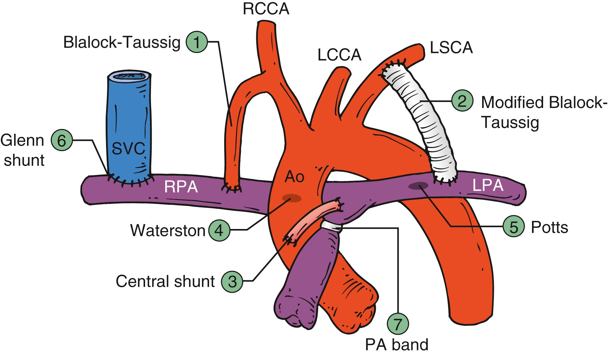 Figure 144.1, Palliative operations. 1, The classic Blalock-Taussig shunt is an anastomosis of the subclavian artery to the ipsilateral pulmonary artery (PA). 2, The modified Blalock-Taussig shunt uses a prosthetic tube interpositioned between the subclavian artery and PA. 3, A central shunt is a prosthetic tube that connects the ascending aorta (Ao) to the main (central) PA. 4, The Waterston shunt is a side-to-side anastomosis between the ascending Ao and right pulmonary artery (RPA). 5, The Potts shunt is a side-to-side anastomosis between the ascending Ao and left pulmonary artery (LPA). 6, A classic Glenn shunt is an anastomosis between the superior vena cava (SVC) and RPA. 7, Used to restrict pulmonary blood flow, a PA band is a constricting band placed around the MPA. LCCA , Left common cardiac artery; LSCA , left subclavian artery; RCCA , right common cardiac artery.