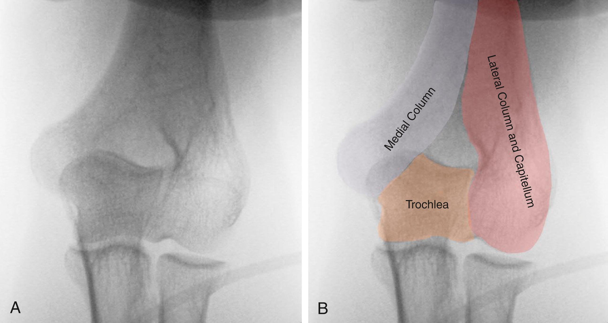 Fig. 36.1, (A) and (B) Normal anteroposterior radiographs of a left elbow. The lateral column extends distally and includes the capitellum. The medial column extends to the medial epicondyle and is connected to the trochlea by a thin corridor of bone.