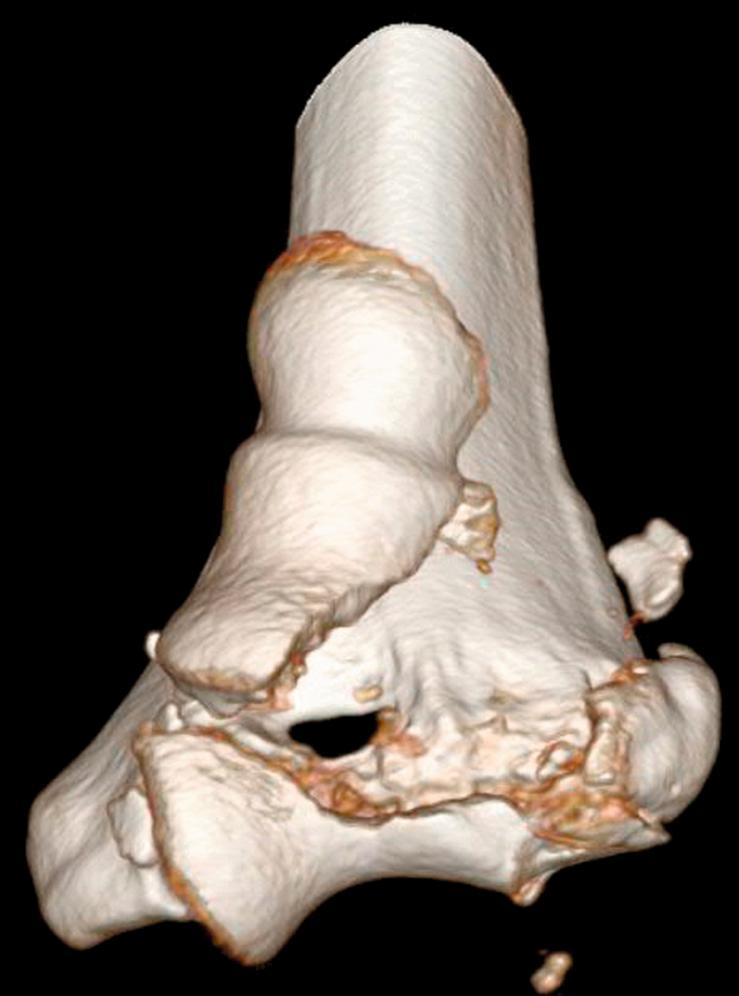 Fig. 36.13, Three-dimensional computed tomography reconstruction of a complex intercondylar distal humerus fracture. There is an articular fracture of the capitellum and lateral trochlea, as well as the lateral epicondyle.