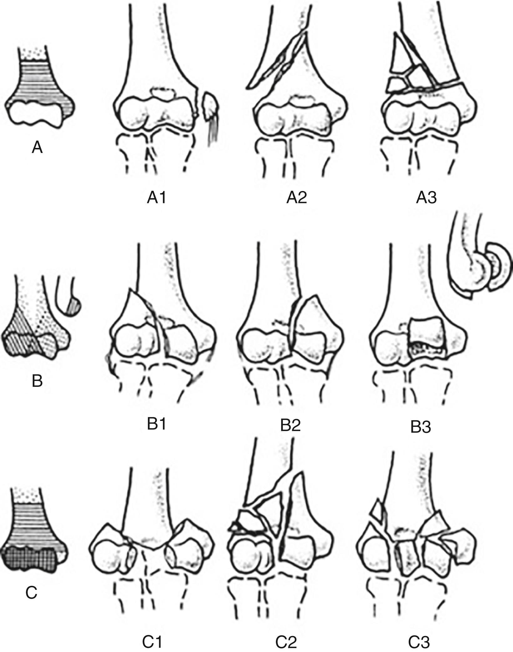 Fig. 36.16, The AO/OTA (AO Foundation/Orthopaedic Trauma Association) classification system provides an effective framework for discussing and treating distal humerus fractures. (Wong A, Baratz M. Elbow Fractures. Distal Humerus. J Hand Surg. 2009;34(1):176–190.)