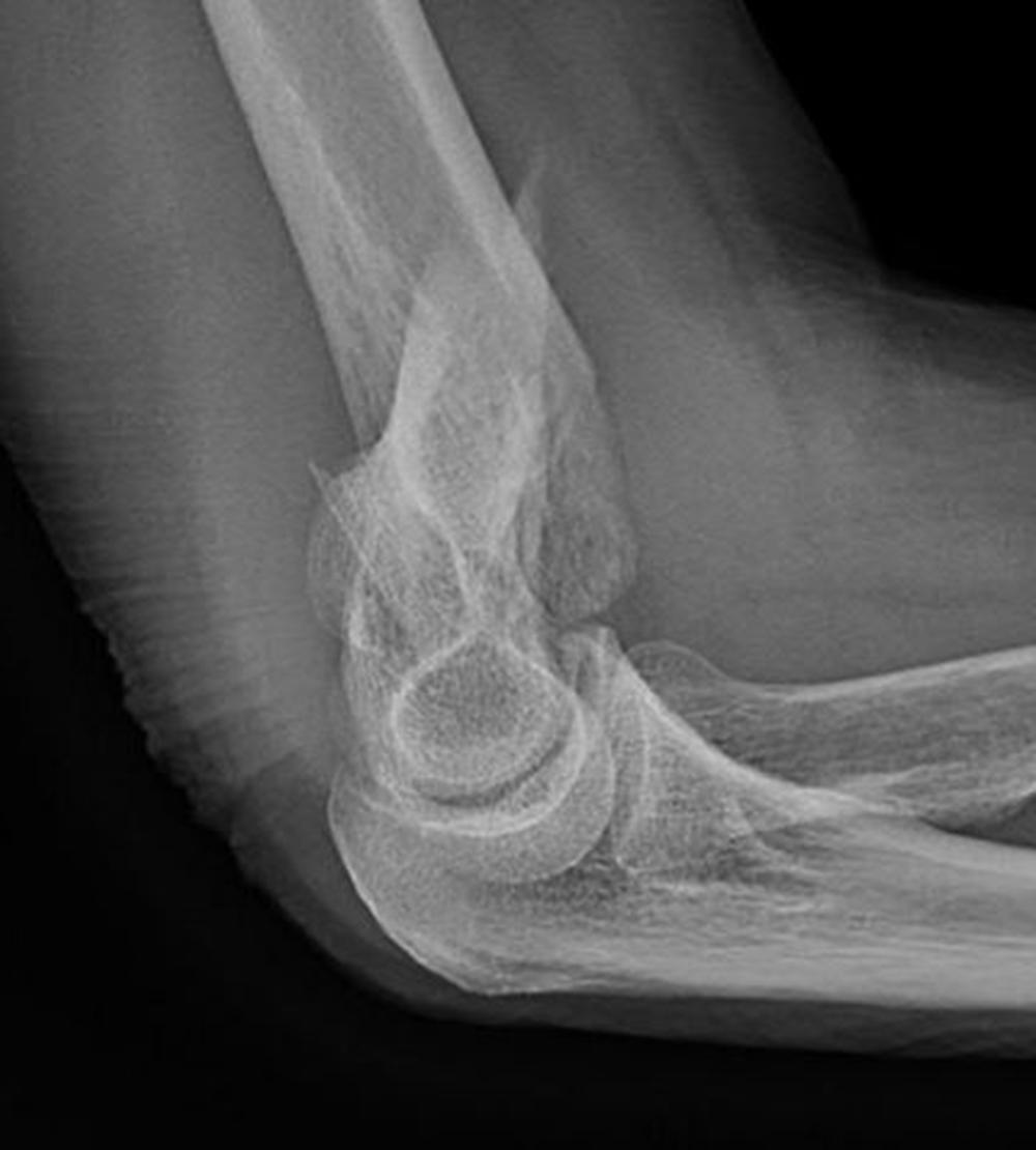 Fig. 36.19, Lateral X-ray of a supracondylar humerus fracture. The lateral fracture exits just proximally to the lateral epicondyle. The fracture does not extend into the joint. This fracture is amenable to a “triceps-on” approach, working on both sides of the triceps.