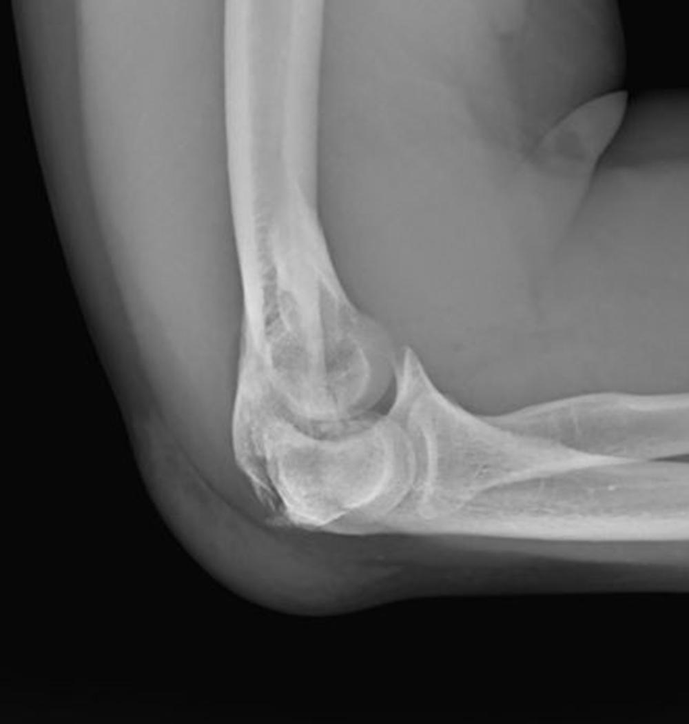 Fig. 36.22, Lateral X-ray of fracture from Fig. 36.21 .