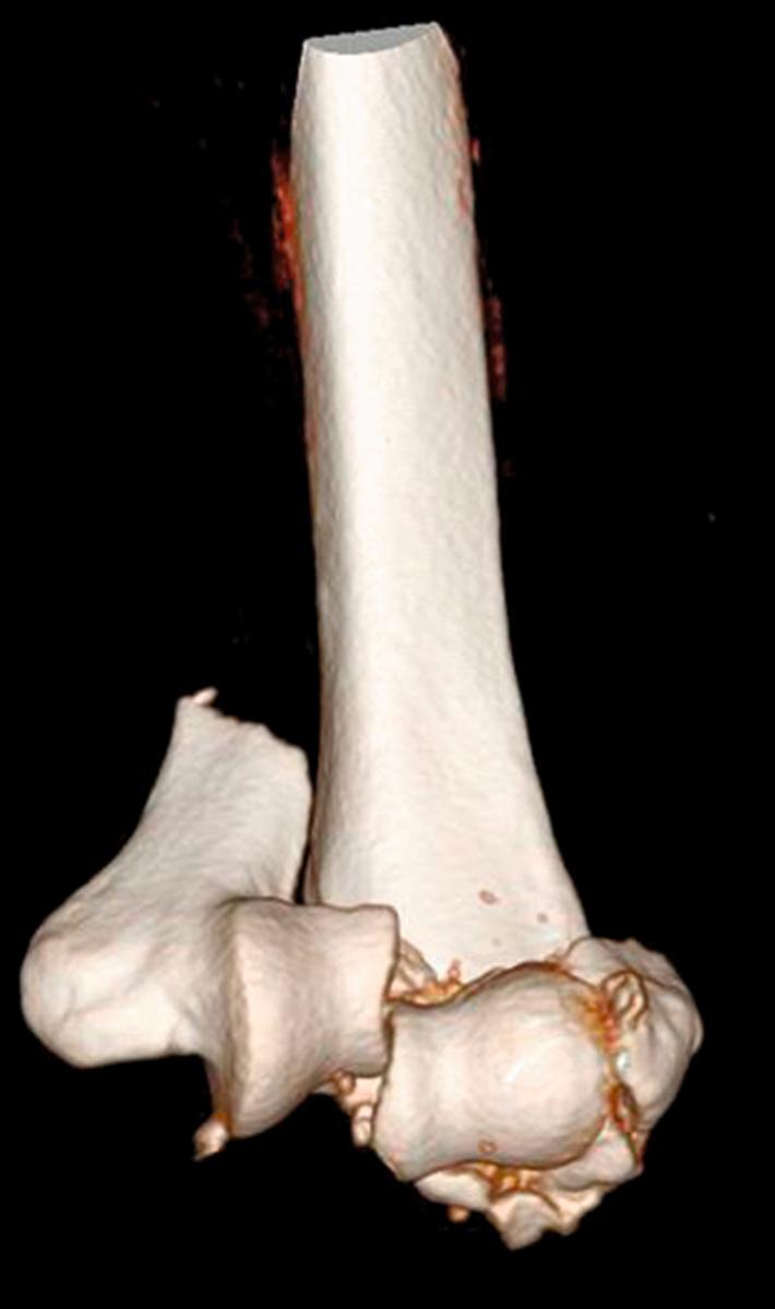 Fig. 36.23, Three-dimensional (3D) reconstruction image of fracture from Figs. 36.21–36.22 , showing comminution of the lateral column.