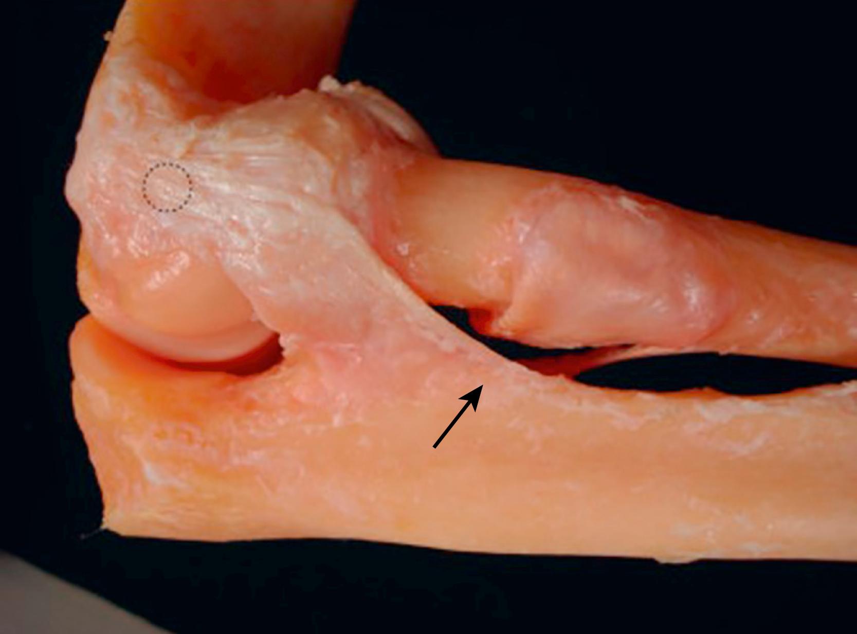 Fig. 36.3, The lateral ulnar collateral ligament complex has a humeral origin at the axis of rotation and inserts into the tubercle of the supinator crest (arrow) . Due to its site of origin on the flexion axis (circle) , it is taut both in extension and in flexion.