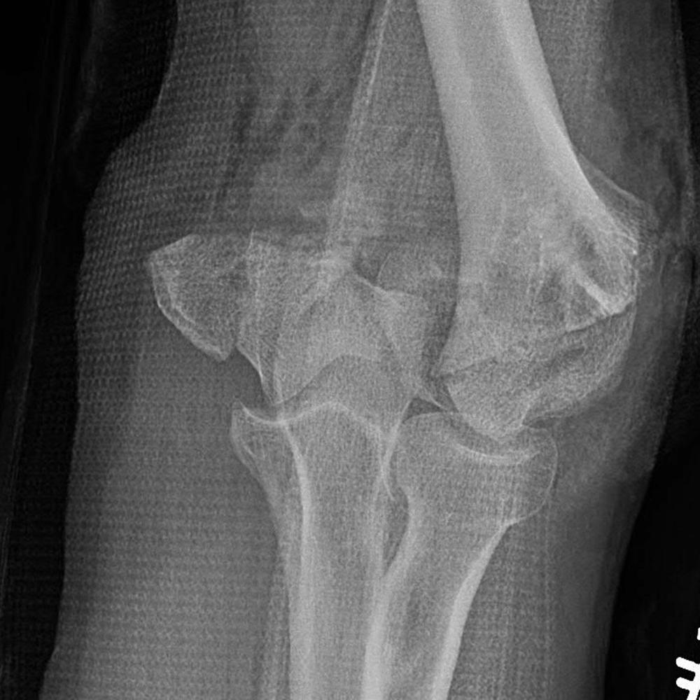 Fig. 36.8, Anteroposterior radiograph of a comminuted left intercondylar humerus fracture. Detailed assessment of fracture fragments is limited on radiographs.