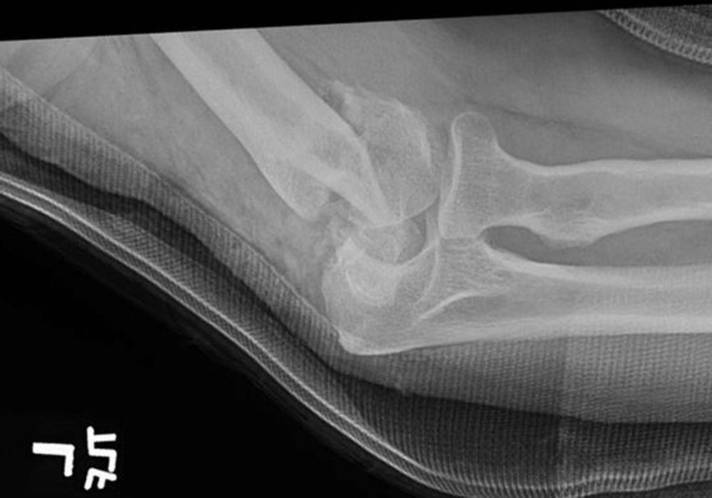 Fig. 36.9, Lateral radiograph of a comminuted left intercondylar humerus fracture. Detailed assessment of fracture fragments is limited on radiographs.