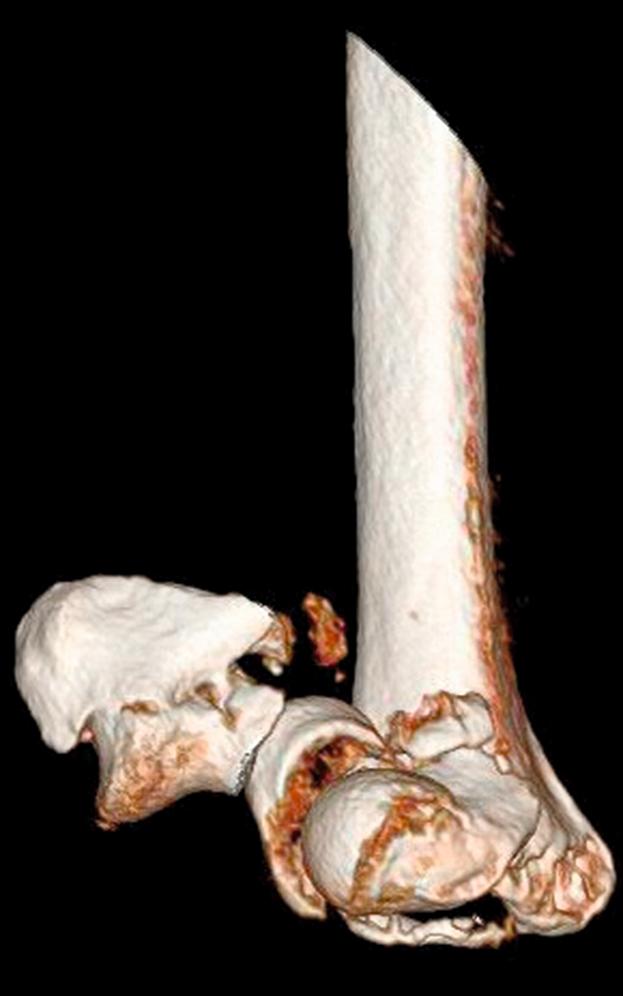 Fig. 36.10, Three-dimensional computed tomography reconstructions allow image manipulation to better understand the fracture fragments. View of the case from Figs. 36.3 and 36.4 shown. Lateral comminution and a fracture between the medial epicondyle and trochlea are apparent.