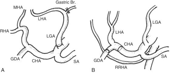 FIGURE 51-2, Advantageous arterial anatomy of the donor in left liver living donor liver transplantation.