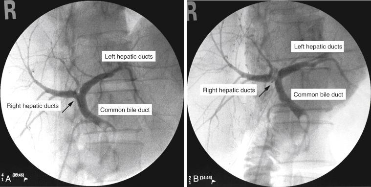 FIGURE 50-1, Intraoperative cholangiogram with radiopaque marker for precise transection of right hepatic duct.