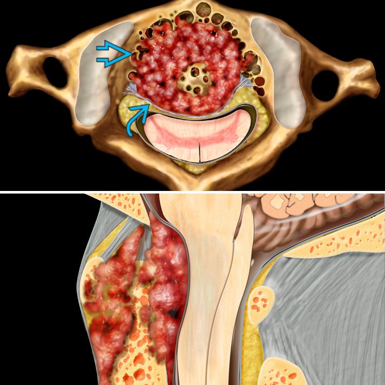 Axial and sagittal graphics show erosion of dens by hypertrophied synovial tissue (pannus). The pannus has eroded the transverse ligament of the dens , resulting in instability. The spinal cord is compressed.