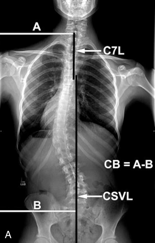 Fig. 51.1, (A) Coronal balance. A line, perpendicular to the floor, is drawn through the middle of the C7 vertebral body (C7L) . The central sacral vertical line (CSVL) is obtained by drawing a line, perpendicular to the floor, through the midline of the sacrum. Distance from the left edge of the radiograph to the C7L (A) is measured, as well as from the left edge of the radiograph to the CSVL (B) . Coronal balance (CB) = A − B. (B) Sagittal plane radiographic parameters: C7 sagittal vertical axis (SVA) ; thoracic kyphosis (TK) , T5–T12; thoracolumbar kyphosis (TLK), T10–L2; lumbar lordosis (LL) , T12–S1. Pelvic incidence (PI) , pelvic tilt (PT) , and sacral slope (SS) .