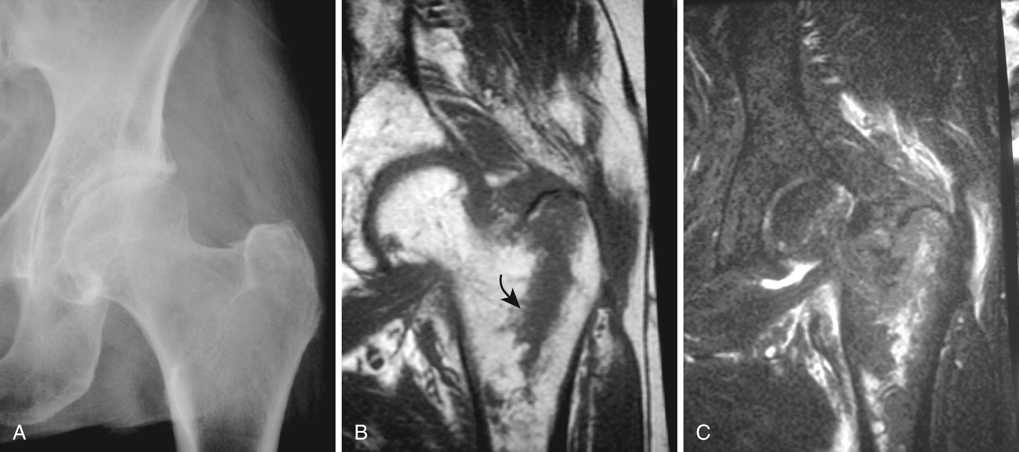 FIGURE 2.28, Radiographically occult proximal femoral fracture in elderly woman. A, Questionable cortical disruption is noted on radiograph of left hip obtained after fall. B, Coronal T1-weighted image confirms greater trochanter fracture manifested as vertically oriented band of reduced signal (curved arrow) within normal bright fat signal of femoral neck. C, Coronal inversion recovery sequence shows edema at fracture.