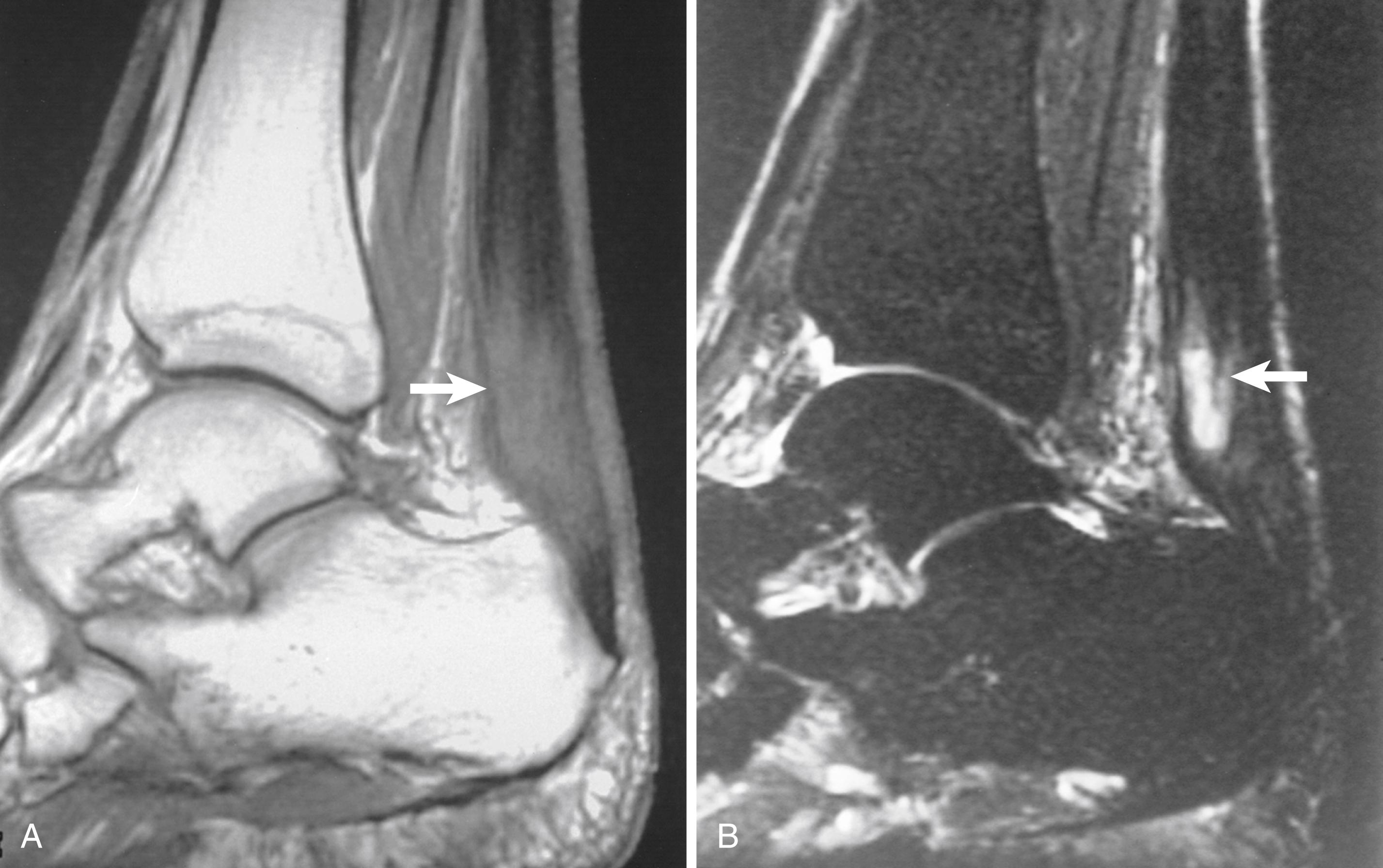 FIGURE 2.3, Partial tear of calcaneal tendon. A, Sagittal T1-weighted image demonstrates markedly thickened calcaneal tendon containing areas of intermediate signal (arrow). B, Sagittal fat-suppressed, T2-weighted image exhibits fluid within tendon substance, indicating partial tear (arrow).