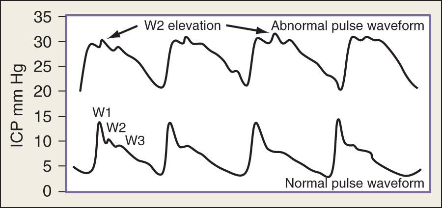 Fig. 42.1, (Upper tracing) Normal intracranial pressure ( ICP ) waveform and its components: W1 (percussion wave), W2 (tidal wave), and W3 (dicrotic wave). (Bottom tracing) As ICP increases, distinctive waveform changes occur (e.g., elevation of the second pulse wave and “rounding” in the ICP waveform).