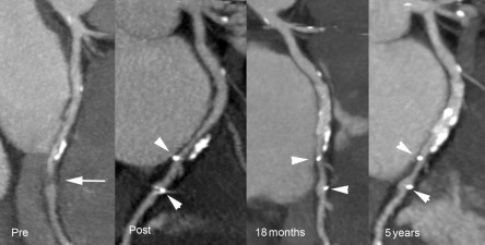 Figure 1.1, Cardiac CT as a research endpoint. Coronary CT angiography depicting a severe stenosis (arrow) in the distal left circumflex branch (PRE). CT imaging performed immediately after (POST) implantation of a bioresorbable coronary scaffold shows two markers at each end of the device (arrow heads). CT imaging confirms patency with minimal lumen loss during follow up at 18 months and 5 years.