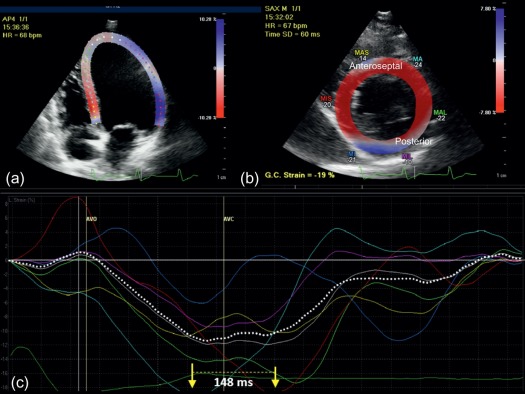 Figure 1.3, Myocardial strain imaging by echocardiography ( Chapter 21 ).