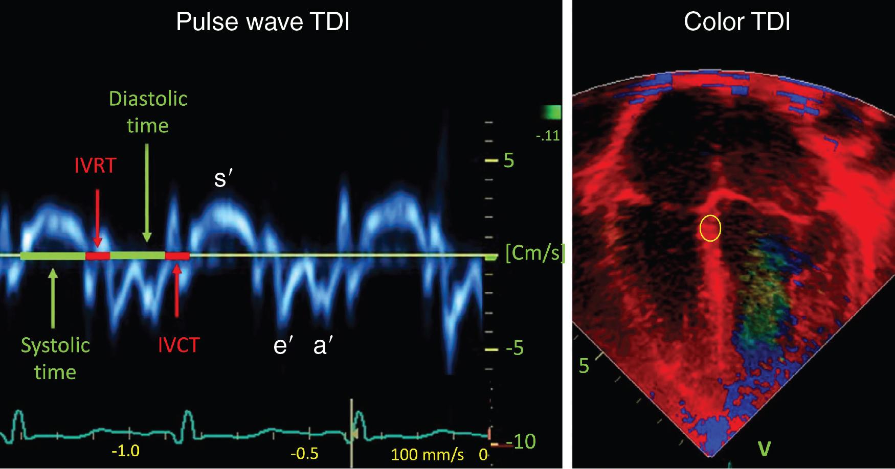 Fig. 11.1, Pulsed wave tissue doppler imaging (TDI) and color TDI.