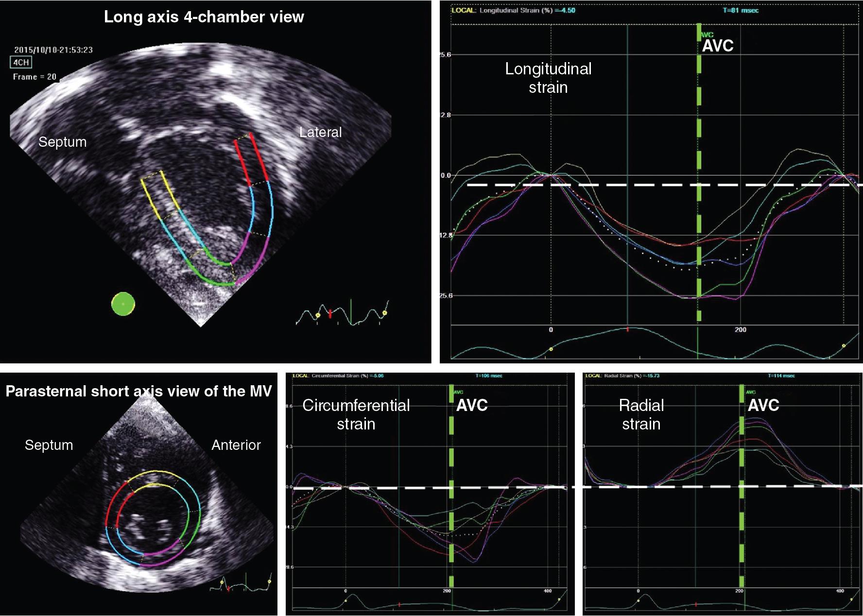 Fig. 11.2, Two-dimensional speckle tracking echocardiography.