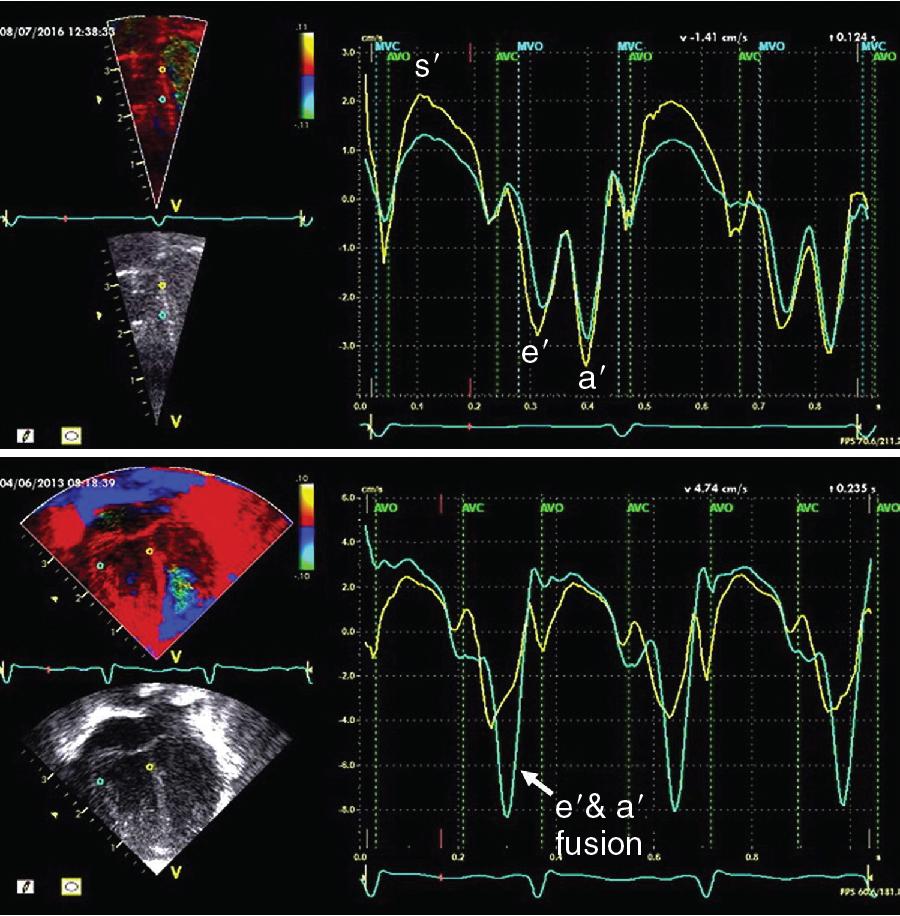 Fig. 11.3, Color tissue Doppler imaging.