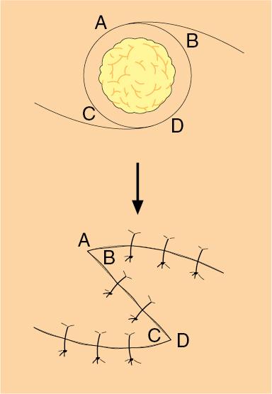 Fig. 64.3, Rotation flap.