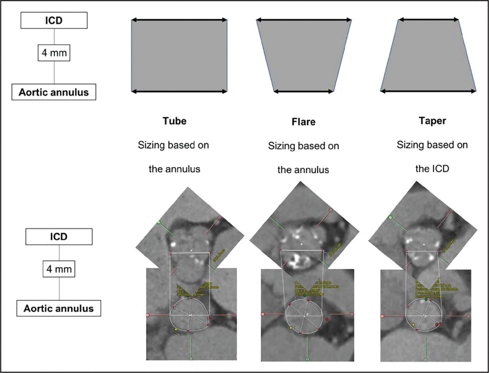 Fig. 12.2, Example Bicuspid TAVI Sizing Algorithm.