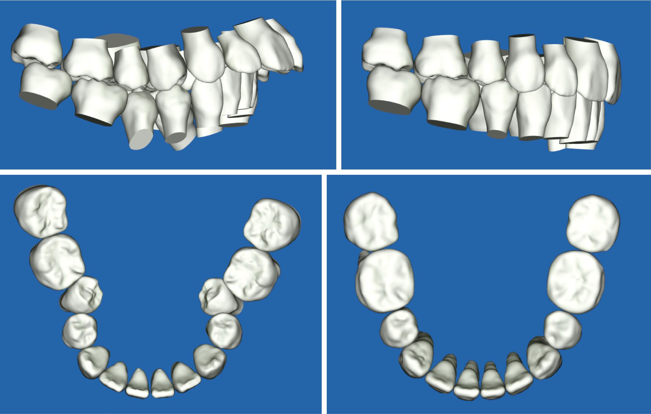 Fig. 18.3, Initial diagnostic simulation showing extraction of premolars to improve alignment and occlusion.