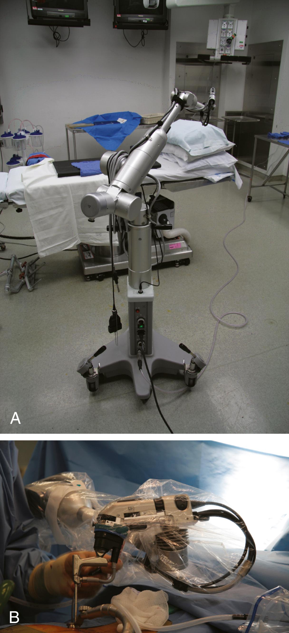 Figure 34.2, (A) Olympus EndoArm (Olympus, Melville, NY), a pneumatic endoscope holder. (B) Olympus EndoArm holding a rod-lens endoscope during surgery.