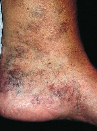 Figure 2.4, Telangiectasia in the medial ankle/pedal area in a patient with chronic venous insufficiency, referred to as corona phlebectatica.