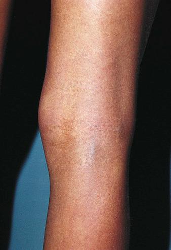 Figure 2.7, Subtle, asymptomatic varicosity of the great saphenous vein at the junction in the popliteal fossa of an 11-year-old girl. There is no significant family history of varicose veins.