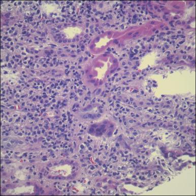 Fig. 18.3, Acute interstitial nephritis complicating immune checkpoint inhibitor therapy. Treatment with immune checkpoint inhibitors can cause acute interstitial nephritis, which is the most common kidney lesion seen. In this image, a diffuse interstitial infiltrate composed of inflammatory cells (lymphocytes, plasma cells, eosinophils) is observed (hematoxylin and eosin stain).