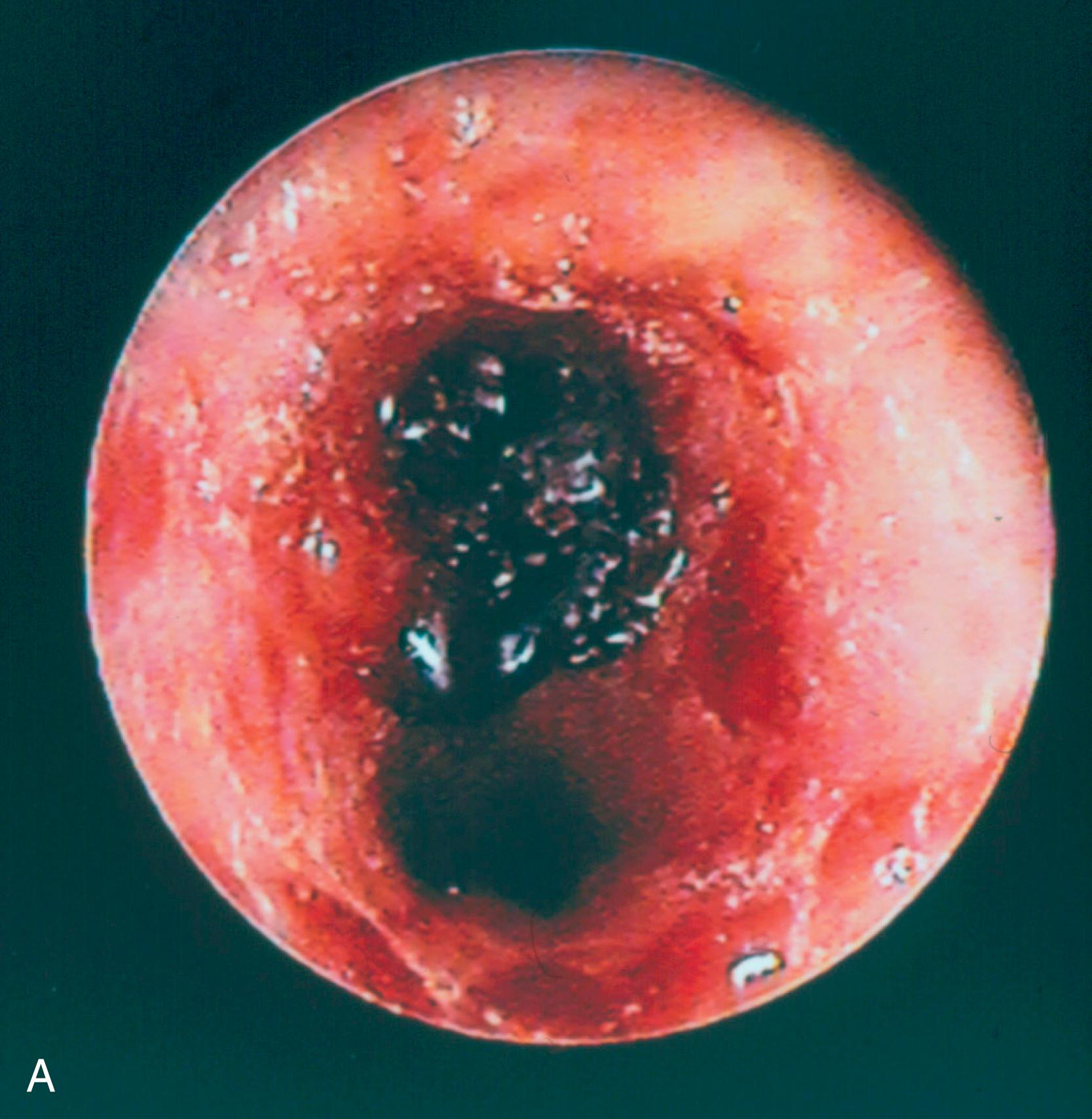 Fig. 34.1, Aspirated organic matter. (A) Inhaled organic matter lodged in the right mainstem bronchus with surrounding inflammatory change of the tracheobronchial mucosa. (B) Nuts and seeds retrieved from the airway shown on an operating room back table.