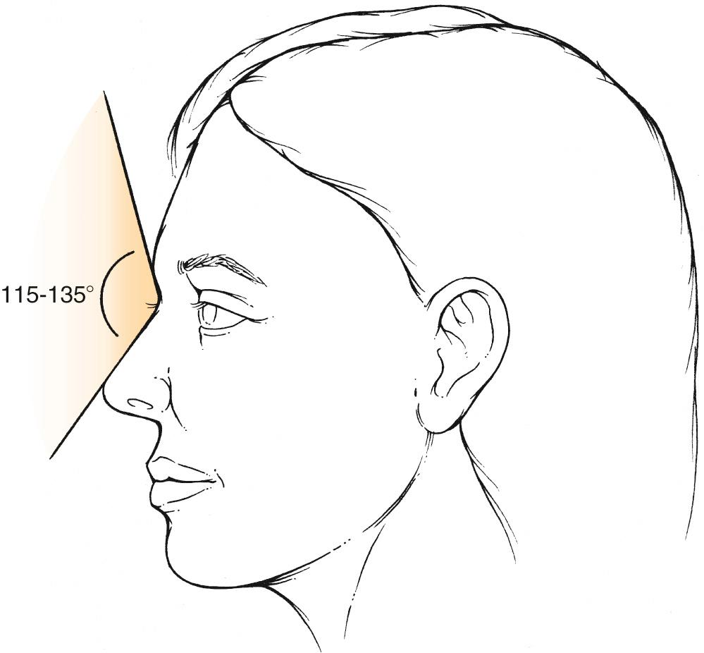 Fig. 16.12, Nasofrontal angle (115–135 degrees).