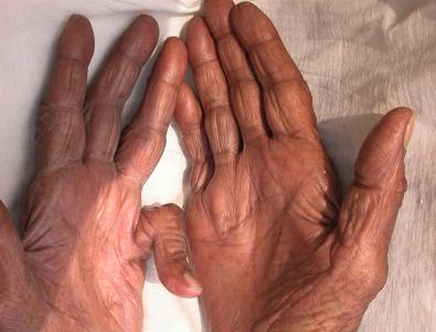 FIGURE 37.1, The aging hand.