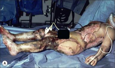 Fig. 59.1, (A) Sixty percent full-thickness total body surface area (TBSA) burn. (B) A comprehensive rehabilitation team approach is necessary to achieve good functional and aesthetic outcomes.