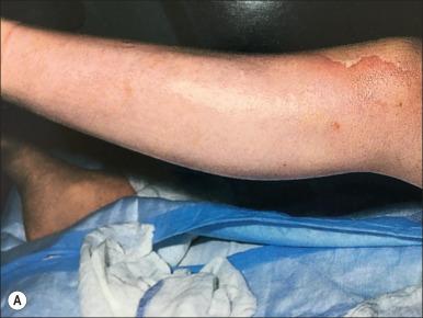 Fig. 59.2, (A) Second-degree burn to the lower extremities. (B) Same patient at 2 months. Erythema, hyperpigmentation, and scarring are present. (C) Result at 18 months with conservative treatment. Scarring is minimal with good overall result. In many cases scar maturation renders optimal outcomes and allows good planning for reconstructive planning if necessary.