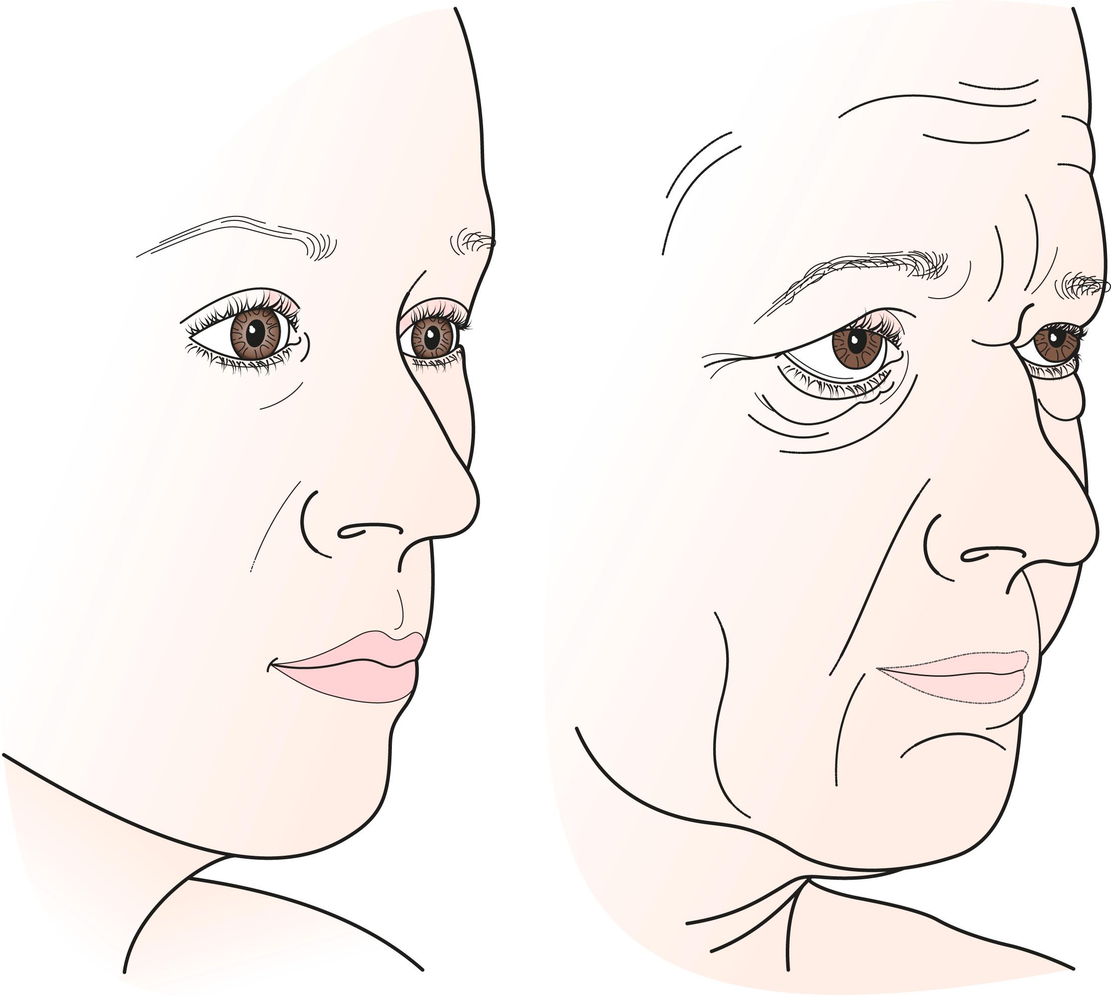 Figure 7.1, The aging face. Note typical involutional changes of the face, including descent of tissues, loss of subcutaneous fat, and deepening of skin wrinkles. Aging creates predictable sags and bags: temporal brow droop, dermatochalasis, fat prolapse in the eyelids, lower eyelid laxity, malar mounds, deepening of the nasojugal fold (tear trough) and melolabial fold, marionette lines, jowling, loss of the sharp angle between the neck and chin, and cervical banding.