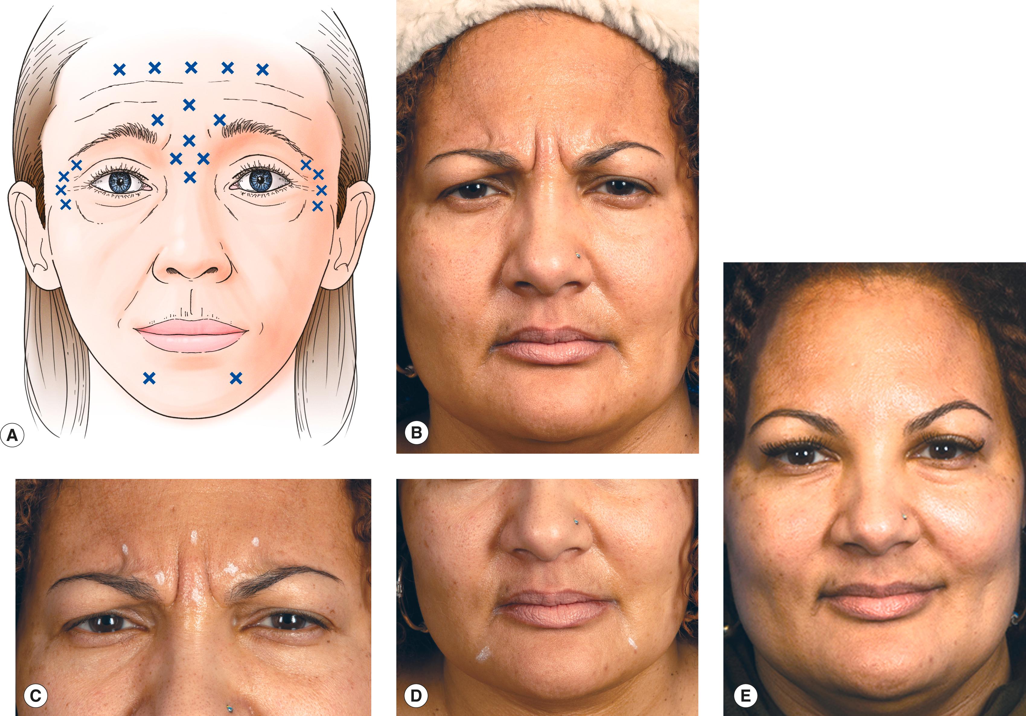 Figure 7.11, Botox injection sites. ( A ) Botox injection sites for forehead furrows, glabellar lines, and crow’s feet. Forehead furrows 10 to 12.5 units total. Glabella 15 to 30 units total. Crow’s feet 7.5 to 10 units per side. Depressor anguli oris 2.5 units per side. ( B ) Before Botox injections the patient has a very unapproachable, stern look, largely owing to glabellar folds. ( C ) Injection sites for the glabella, in this case 30 units, and an additional 7.5 units at the lateral canthal region to raise the lateral eyebrow. No forehead injections were given. ( D ) Injection sites to weaken the depressor anguli oris muscle 2.5 units per side. ( E ) Following the injections the patient appears less angry and more friendly, with the glabellar fold eliminated, brows slightly higher, and eyes a bit more open and has a better smile.