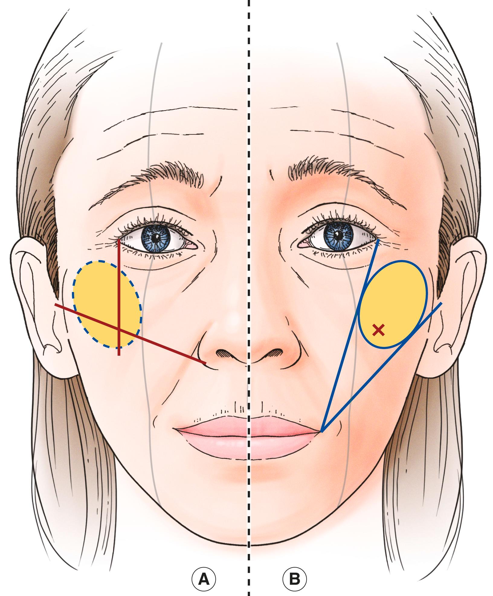 Figure 7.14, The high point of the cheek. Draw a line from the lateral ala to the tragus. The intersection of this line and a line directed inferiorly from the lateral canthus is a good place to create the most anterior cheek projection, marked + on both sides ( A ). Draw a line from the lateral commissure to the tragus and from the lateral commissure to the lateral canthus. These lines define an elliptical area for the best cheek projection ( B ).