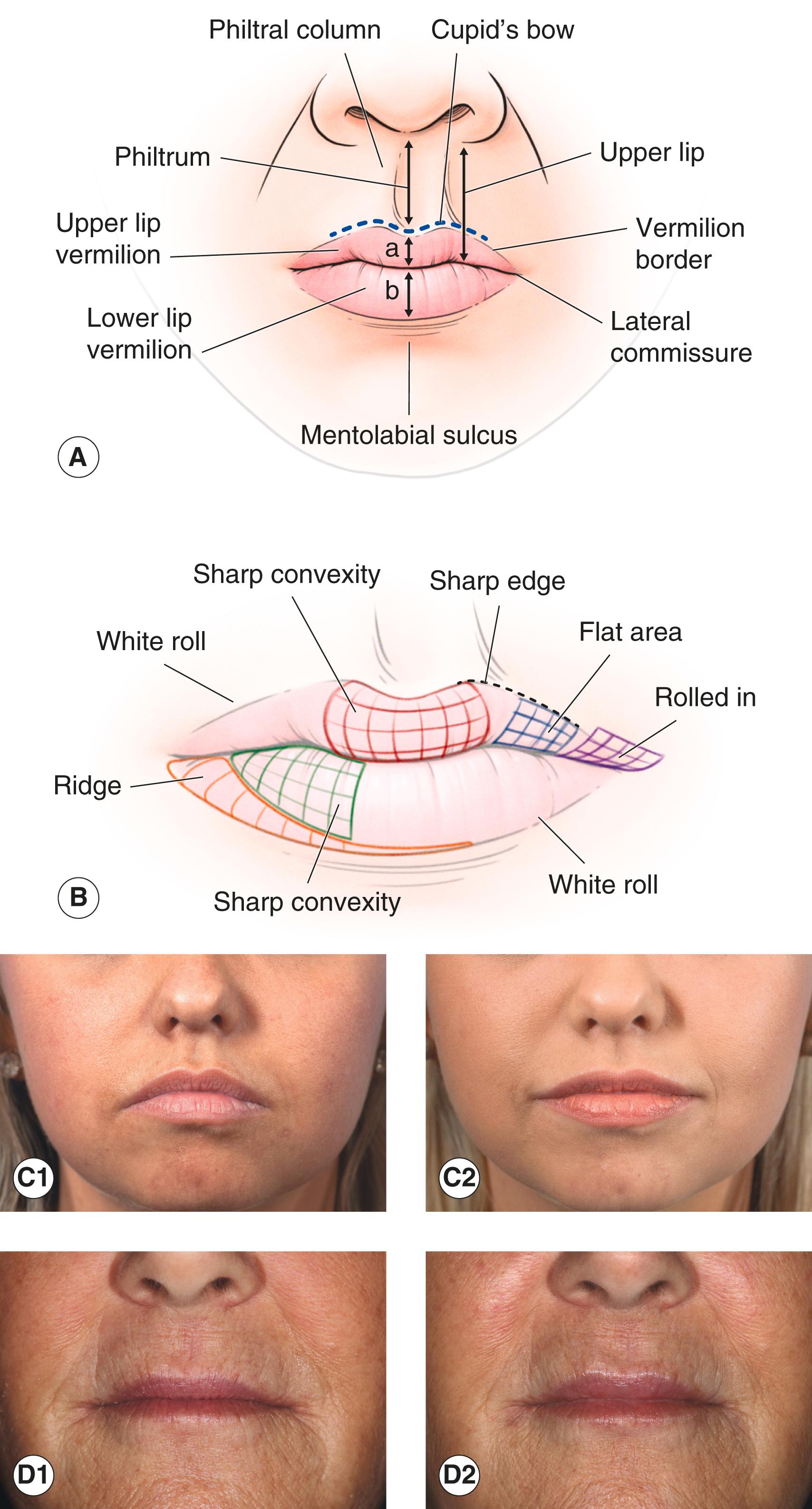 Figure 7.17, ( A and B ) The anatomy of the lip. Keep in mind the three-dimensional character of the lips. ( C1 ) Full lips in a young lady who would like fuller lips. (C2) 1 mL hyaluronic acid filler to soften vermilion border on the white roll, into body of lip, at inferior lateral commissure to raise corners, and in the mentolabial fold. Additional 2.5 Botox units given into each DAO muscle to improve the smile. (D1) Thinning lips in a 60-year-old woman. (D2) Hyaluronic acid filler to strengthen upper and lower vermilion border. Additional filler into the body of the upper and philtral columns to create a subtle Cupid’s bow. Small amount of injection into the upper vertical lip lines directly. Small amount of injection into the body of the lower lip (more fullness could be added for a more luxurious look, but perhaps it would be too much for this patient).