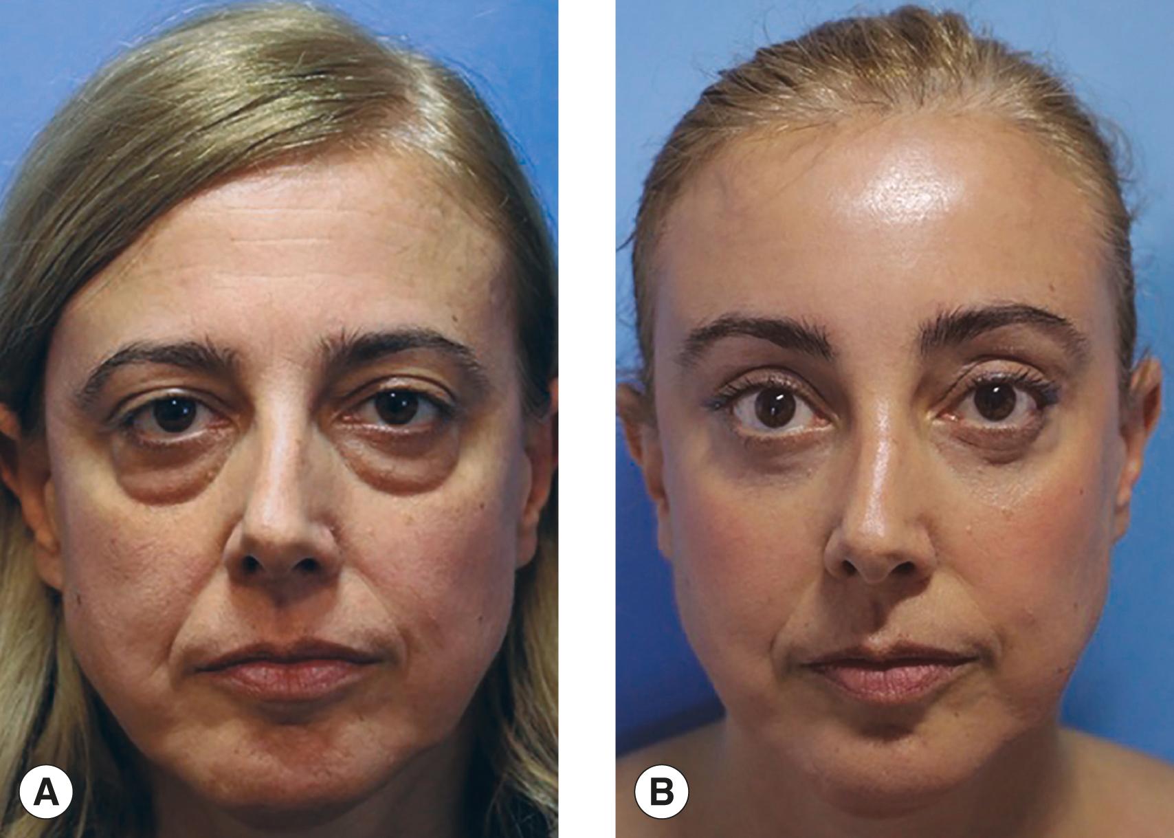 Figure 7.18, Full-face fat injection. Forehead lift and four lid blepharoplasty. ( A ) Before the injection. ( B ) Following the injection and the operation.