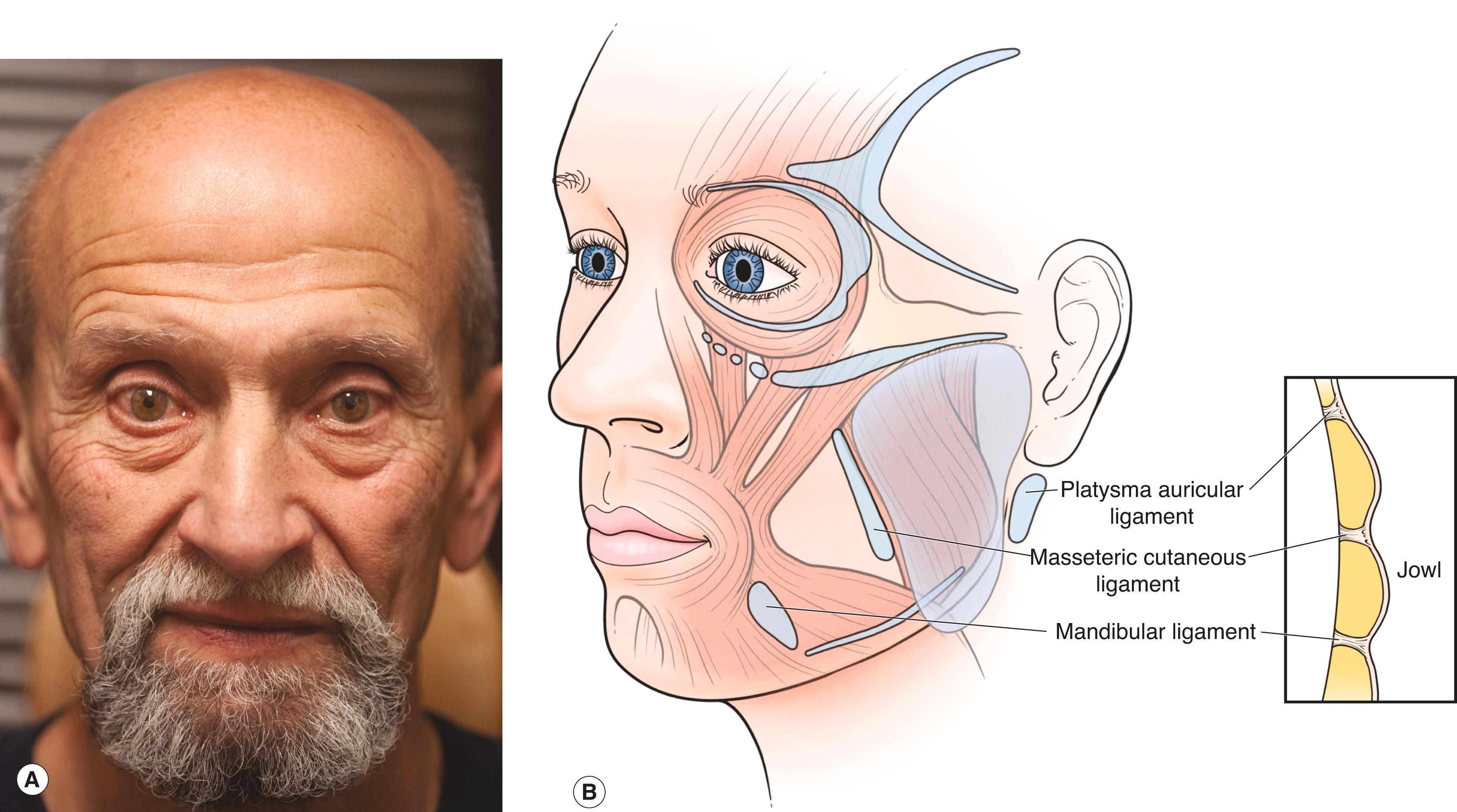 Figure 7.2, ( A ) Facial deflation. Note the hills and valleys creating a loss of smooth transitions across the face seen in youth. ( B ) The retaining ligaments anchor the soft tissues of the face to the underlying soft tissues or bone—creating the “tufting” of our facial “upholstery.”