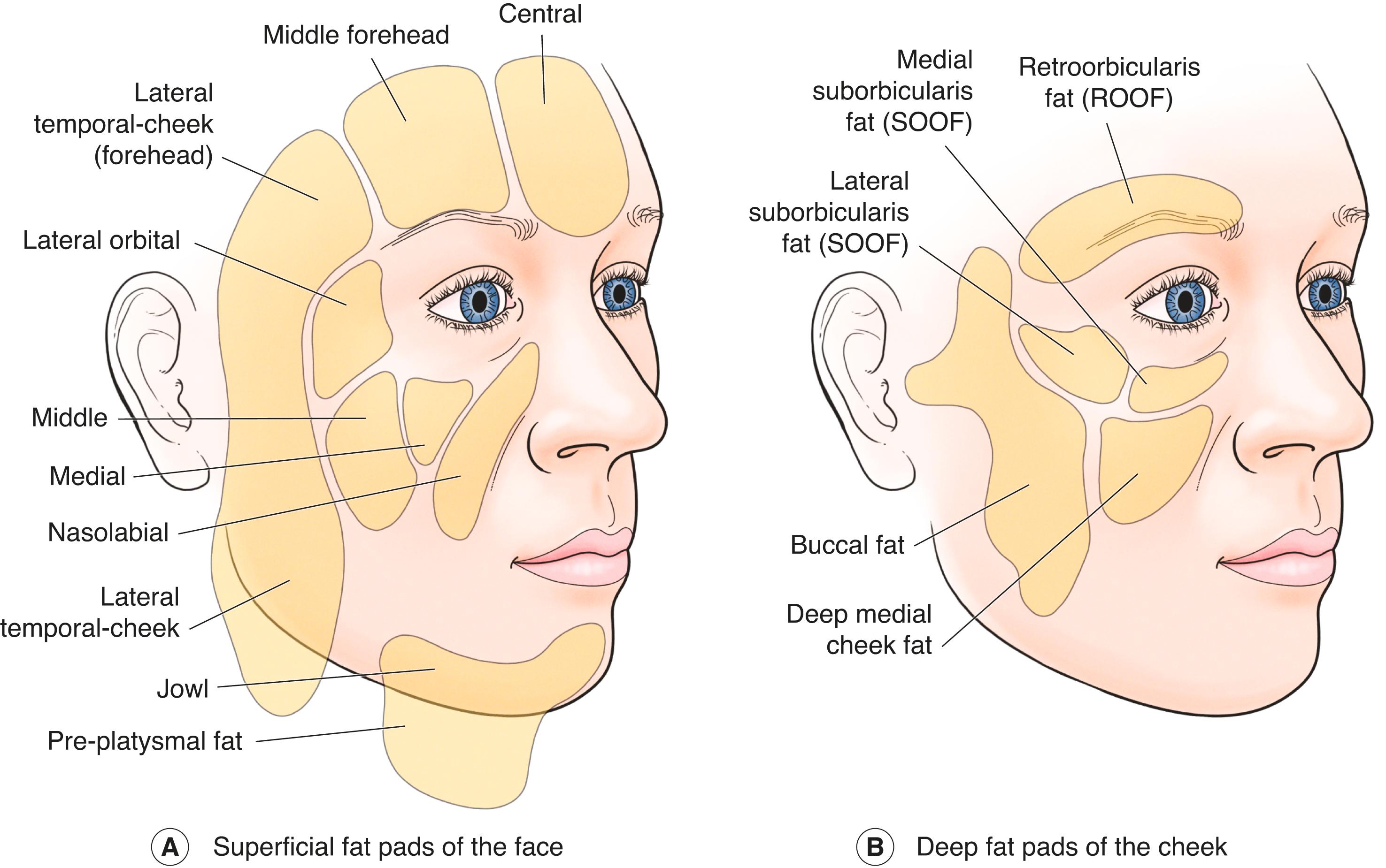 Figure 7.3, The fat pads of the face. ( A ) Superficial and ( B ) deep fat pads. A layer of fat is present on both the anterior and posterior aspects of the SMAS. The suborbicularis fat pads are what we have described as the SOOF.