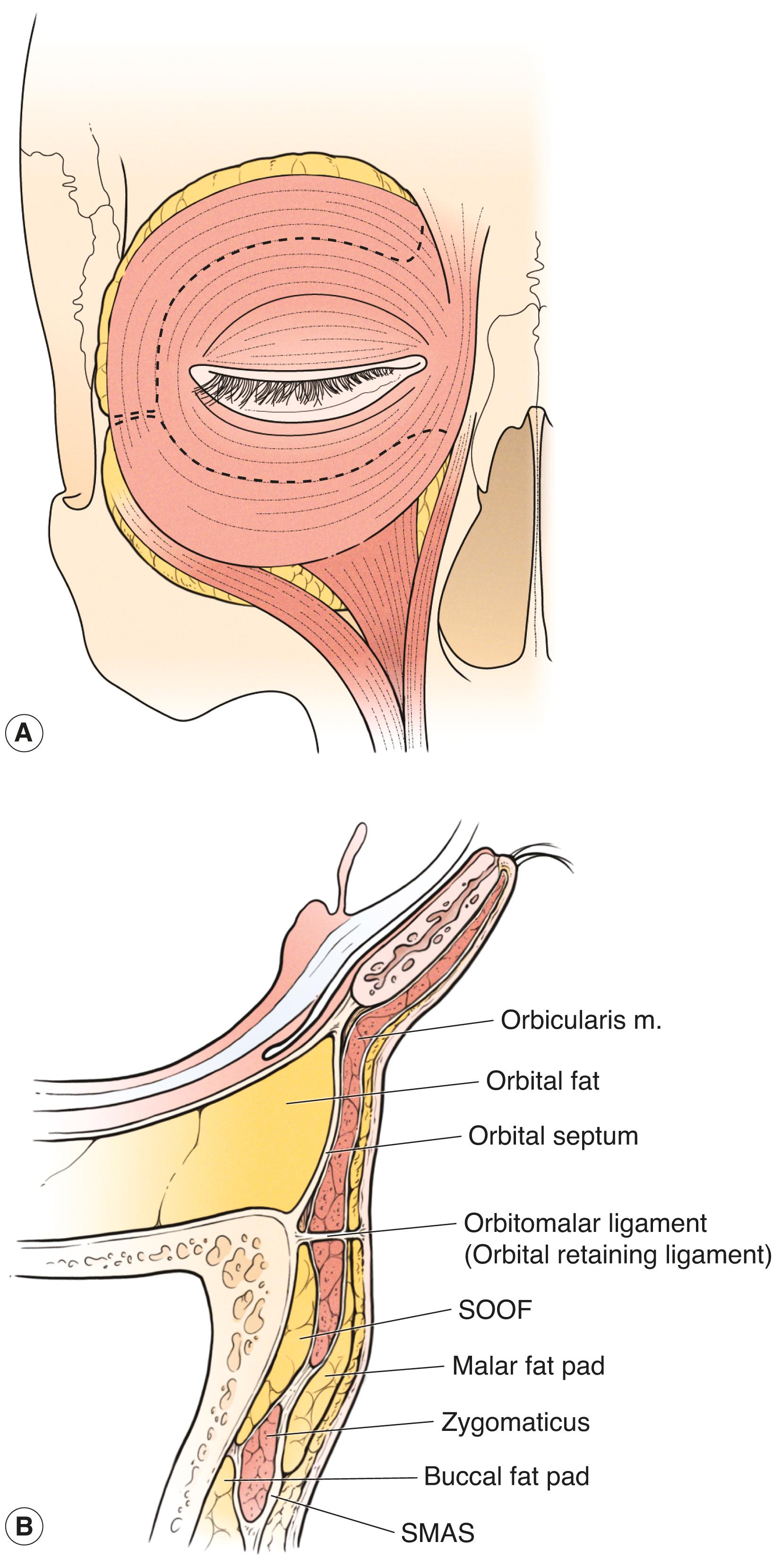 Figure 7.4, ( A ) The SOOF, ROOF, and malar fat pads. The SMAS and its analogous anatomic layers ( B ) are surrounded by layers of fatty tissue that allow the SMAS to move. The SOOF and ROOF are posterior to the orbicularis muscle (SMAS equivalent). The malar fat pad is anterior to the orbicularis muscle.